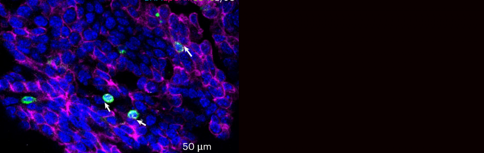 Neutrophils may serve as a target for new therapies and a biomarker for advanced breast cancer