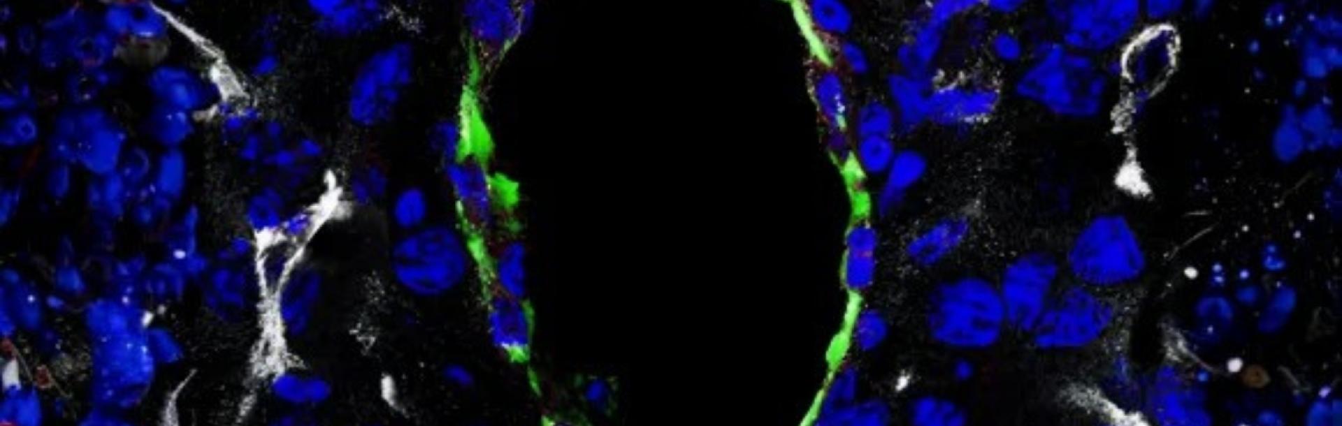 Study reveals how dead cancer cells help tumors grow