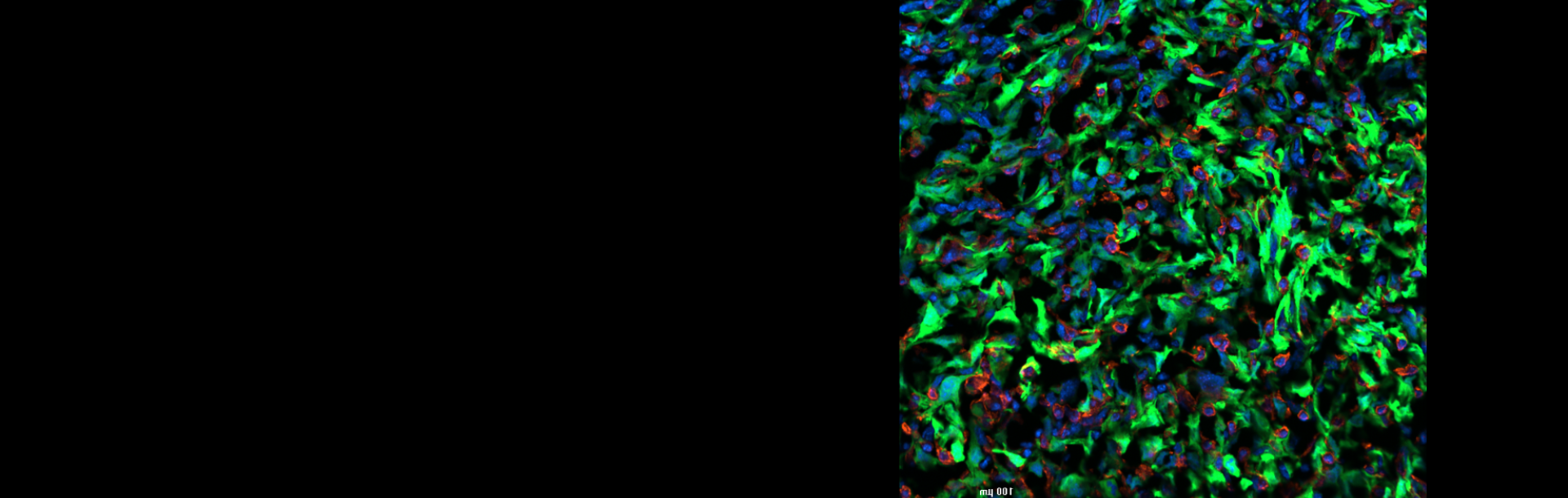 Breast Cancer and the Brain: A Breakthrough in Understanding Metastasis