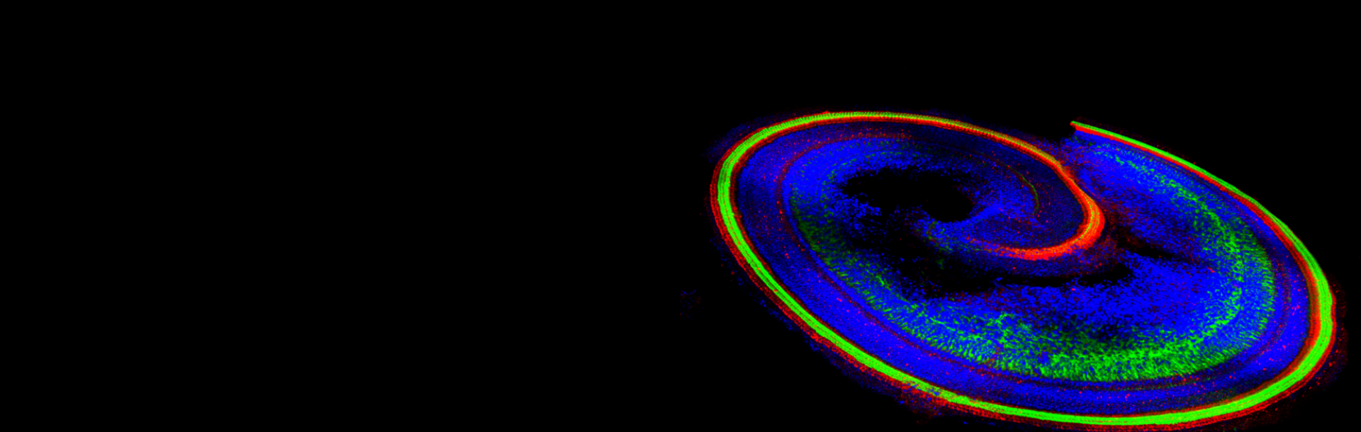 First Time Use of New Form of AAV-Gene Therapy for Deafness