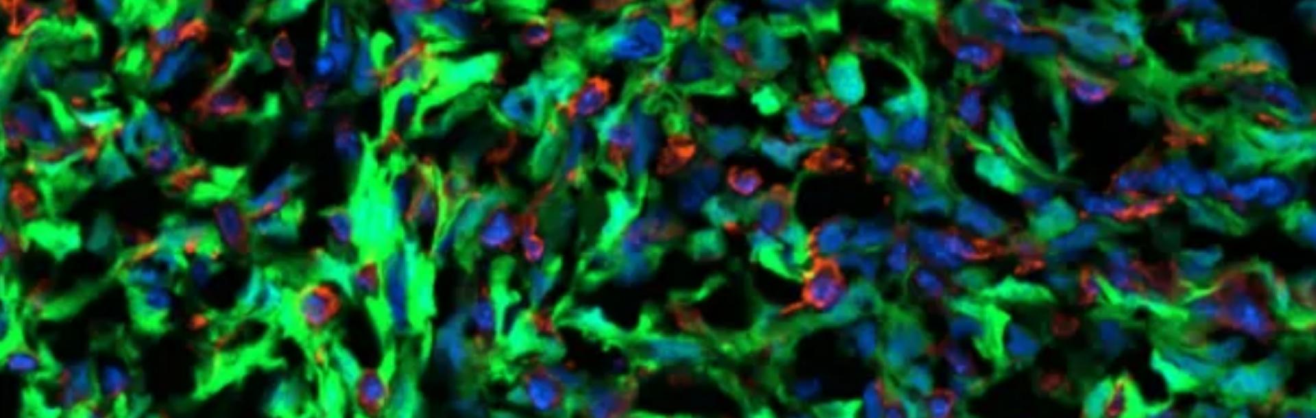 New insight into breast cancer brain metastases