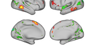 Predicting individual variability in task-evoked brain activity in schizophrenia