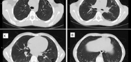Underdetection of interstitial lung disease in juvenile systemic sclerosis