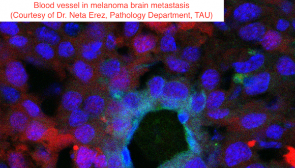 blood vessel in melanoma brain metastasis